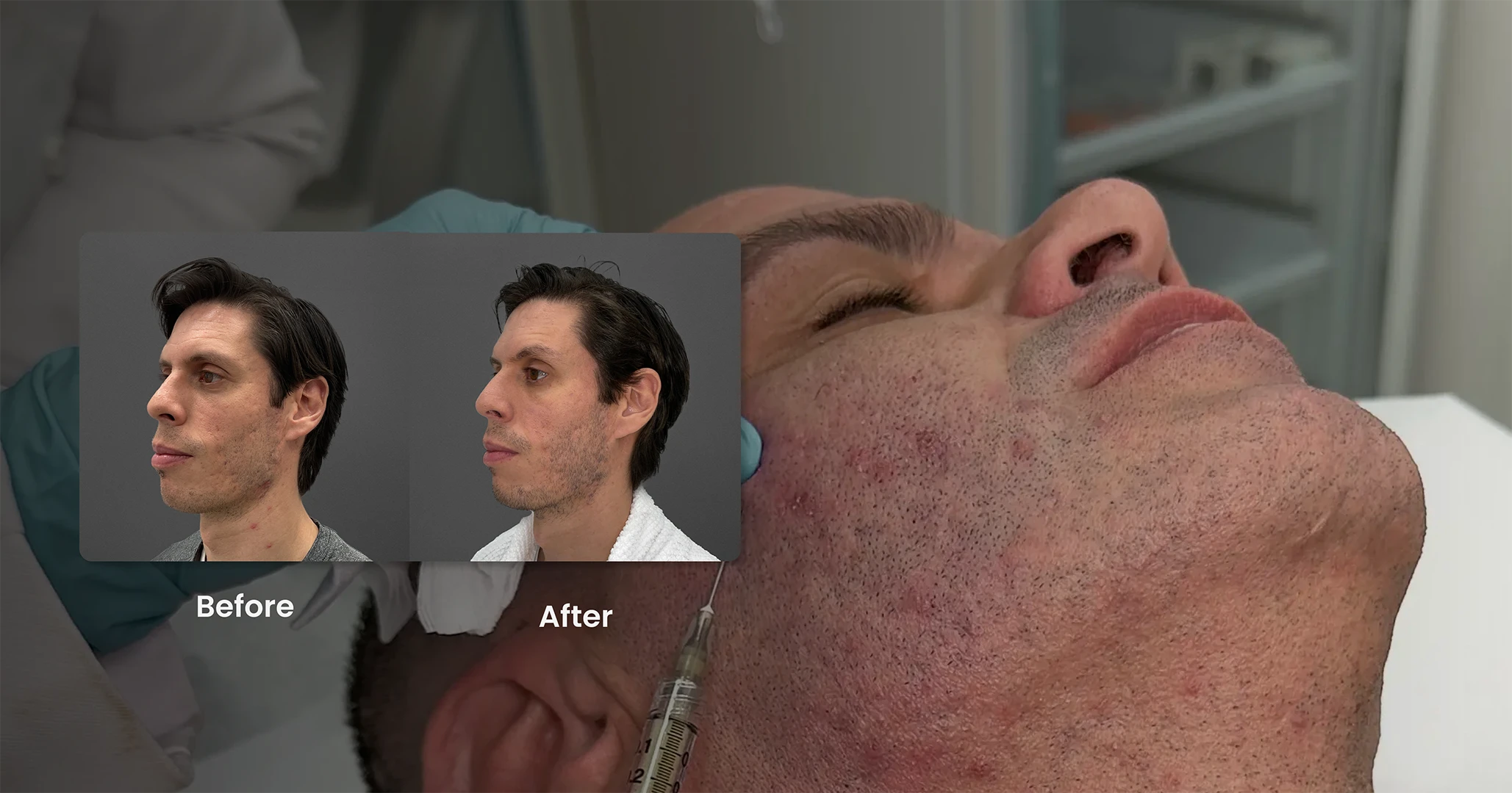 Perfect B - FAQ's - Acne Scars Treatment - Portrait