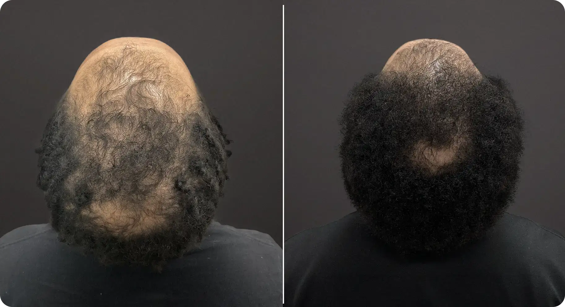 Perfect-B-Blog-PRP-hair-treatment-Image-11