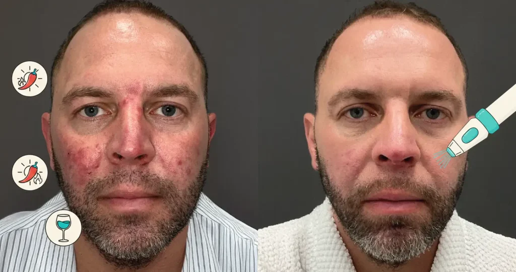 Perfect-B-Blog-Medical-Grade-Lasers-to-Light-Therapy-portrait