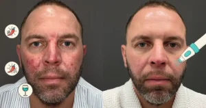 Perfect-B-Blog-Medical-Grade-Lasers-to-Light-Therapy-portrait