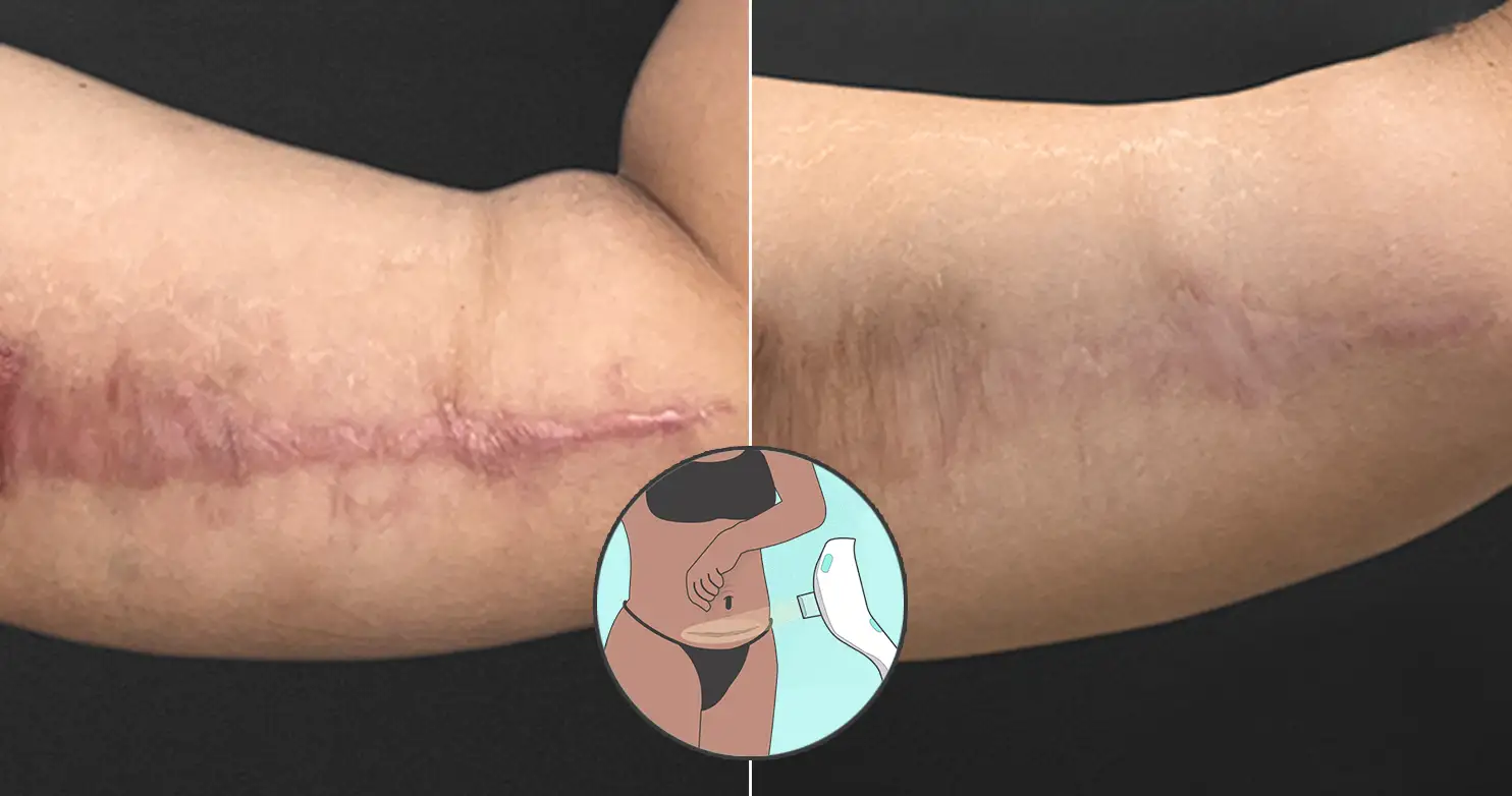 Perfect-B-Blog-Good-Cream-for-Stretch-Marks-portait