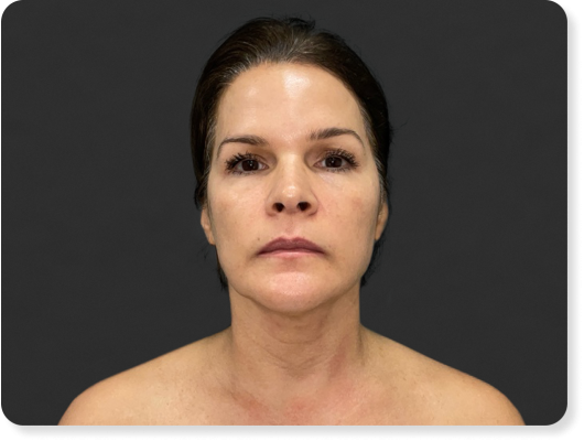 Perfect B - Skin Rejuvenation Treatment - Rejuvenated skin